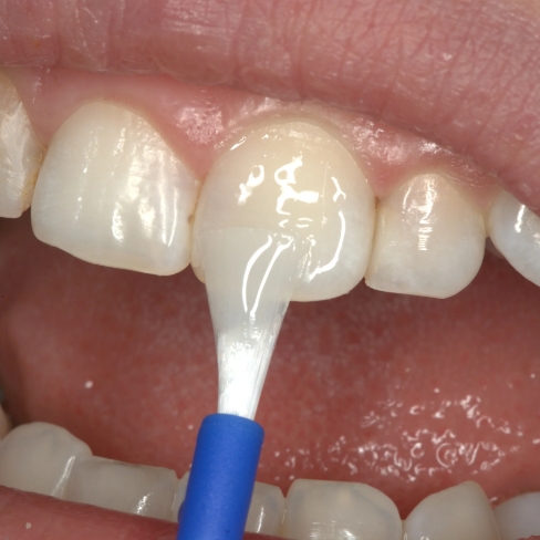 Animated smile during fluoride treatment