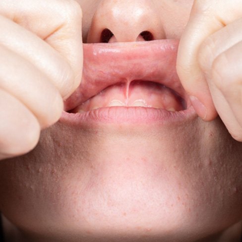 a person folding up their lip