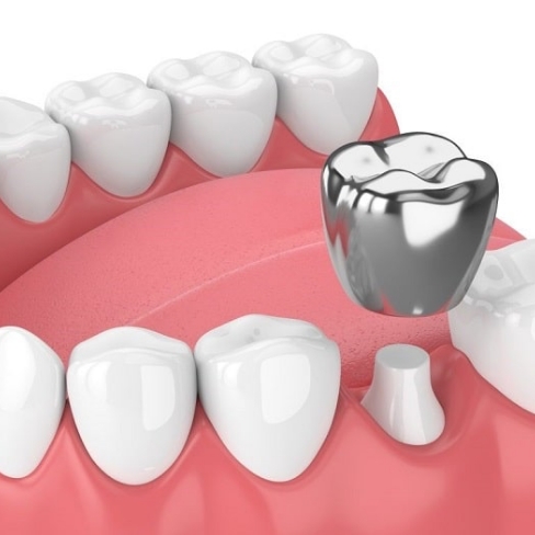 Animated smile during stainless steel dental crown placement